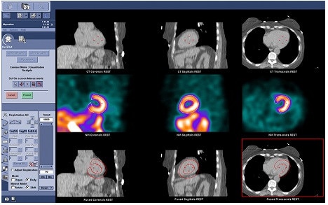 Images-Product-Product-Categories-Nuclear-Medicine-Cardiac-imaging-alcyone-external.jpg